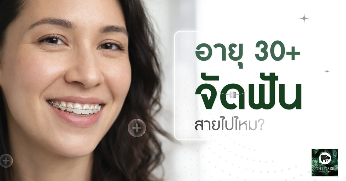 braces-for-adults-30